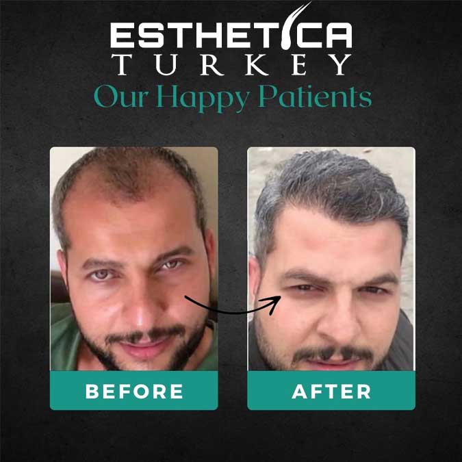 Hair transplant before and after