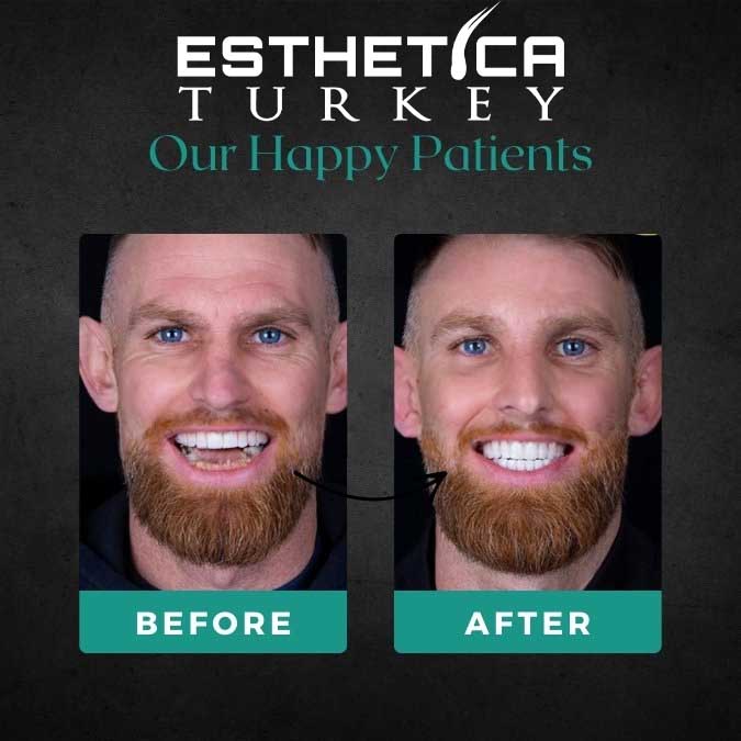 Hair transplant before and after