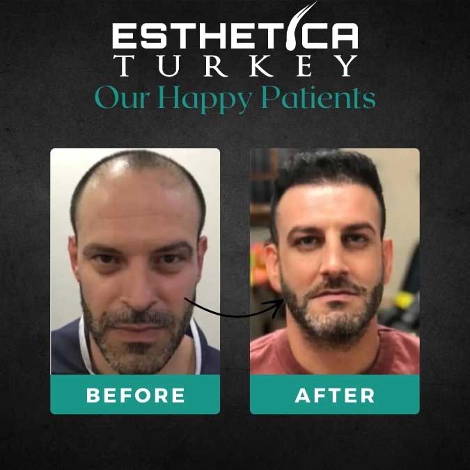 Hollywood smile before and after