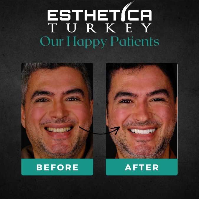 Hair transplant result