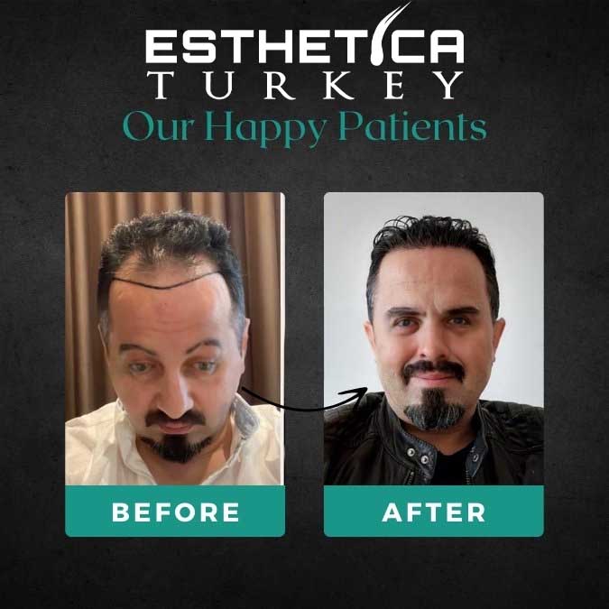 Beard transplant