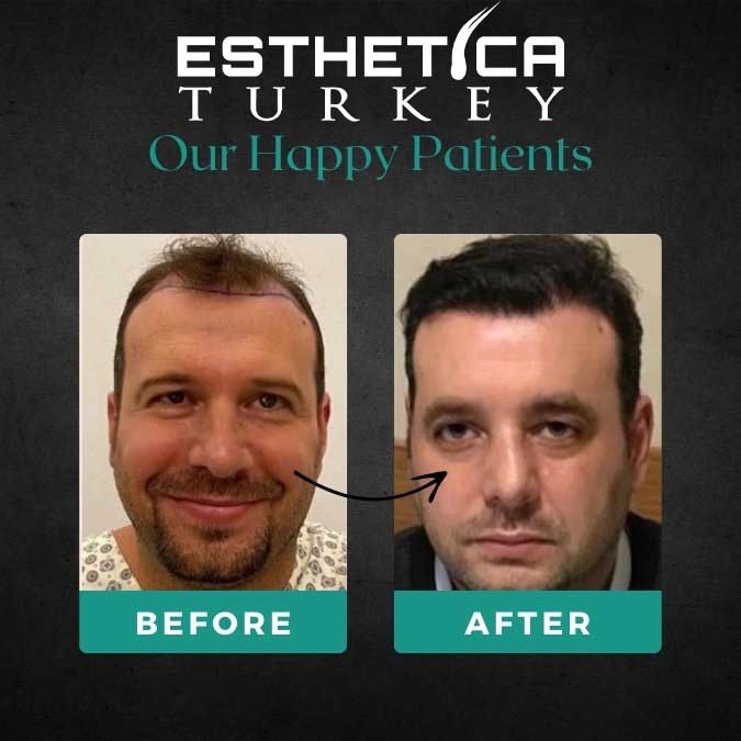 Hair transplant result